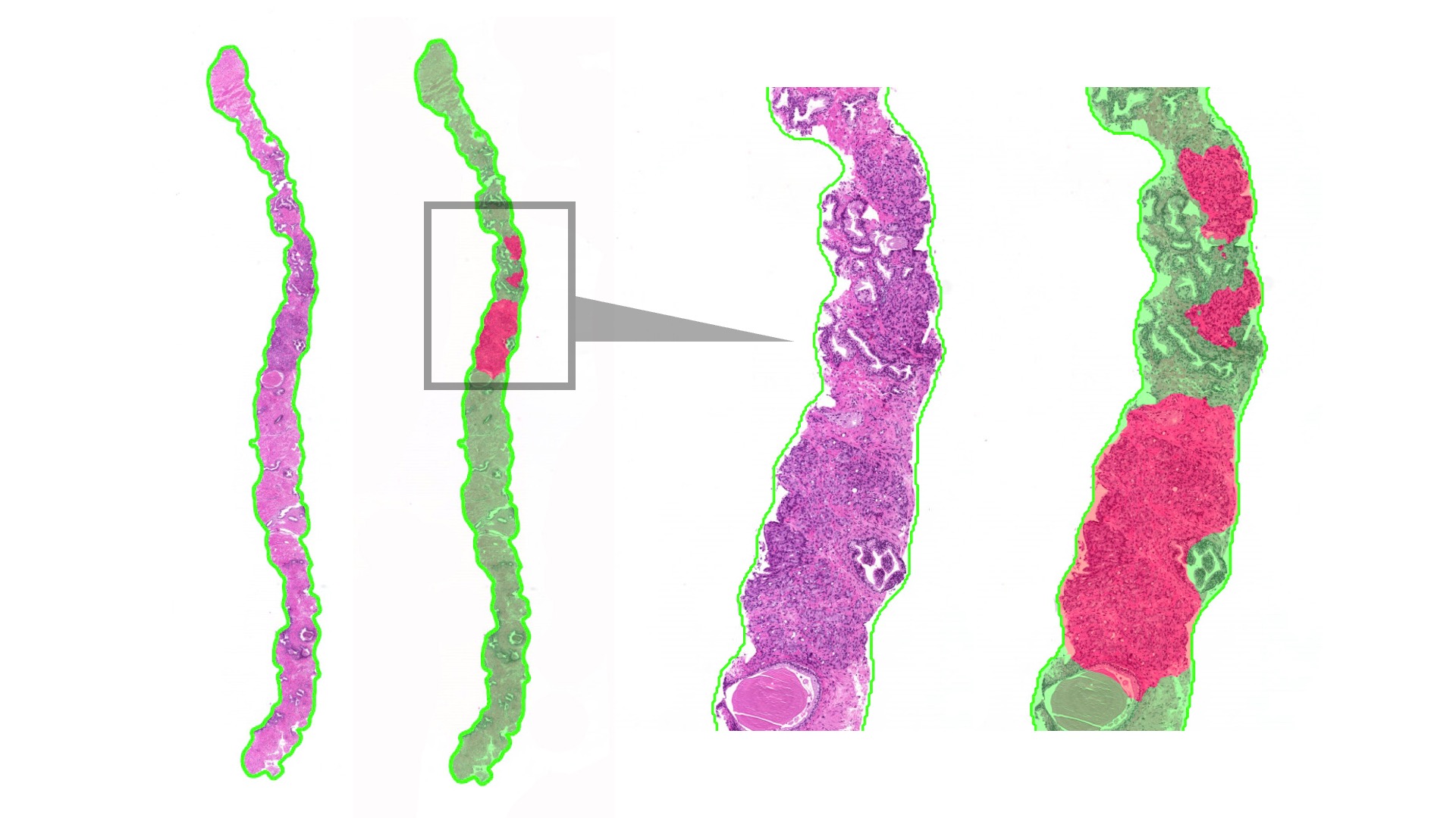 Automated Detection and Gleason Grading of Prostate Cancer in Digital ...