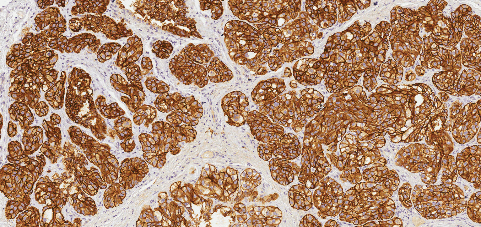 HER2 expression in breast cancer with intense membrane staining.