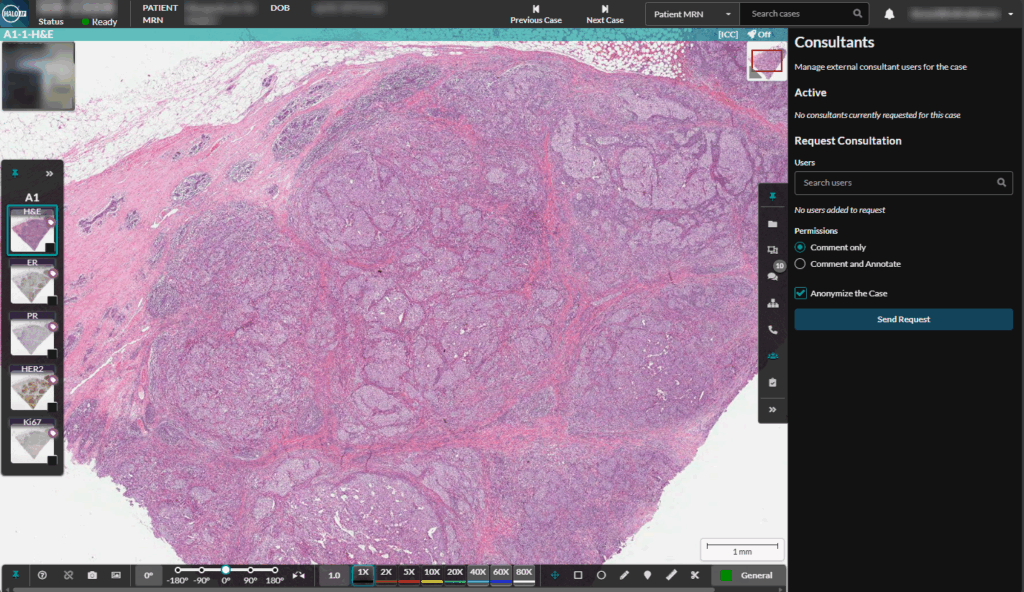 Digital pathology, H&E-stained breast tissue section under 1x magnification. Showing external consultant feature in the HALO AP UI