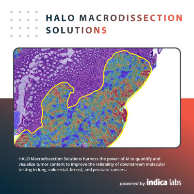 The image shows a colorectal cancer tissue specimen with a heat map of concentrated tumor cells and a yellow annotation line.