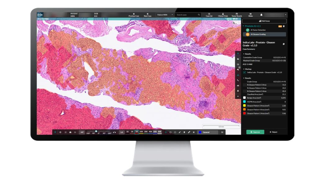 Prostate AI in an ai-powered digital pathology analysis tool for identifying prostate adenocarcinoma and standardizing Gleason grading