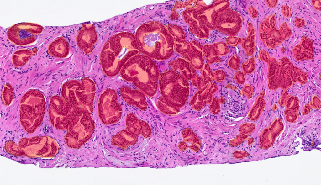 The image shows a core needle biopsy sample from prostate tumor tissue with an AI overlay with Indica Labs Prostate AI, highlighting areas of neoplastic cells