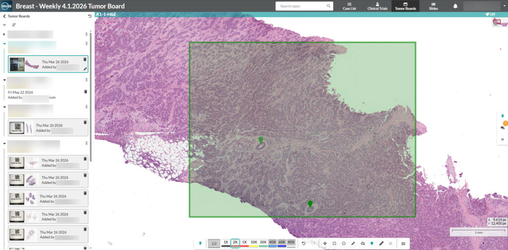 This image shows the HALO AP 2.5 user interface, show casing tumor board 2.0 for multidisciplinary collaboration in diagnostics