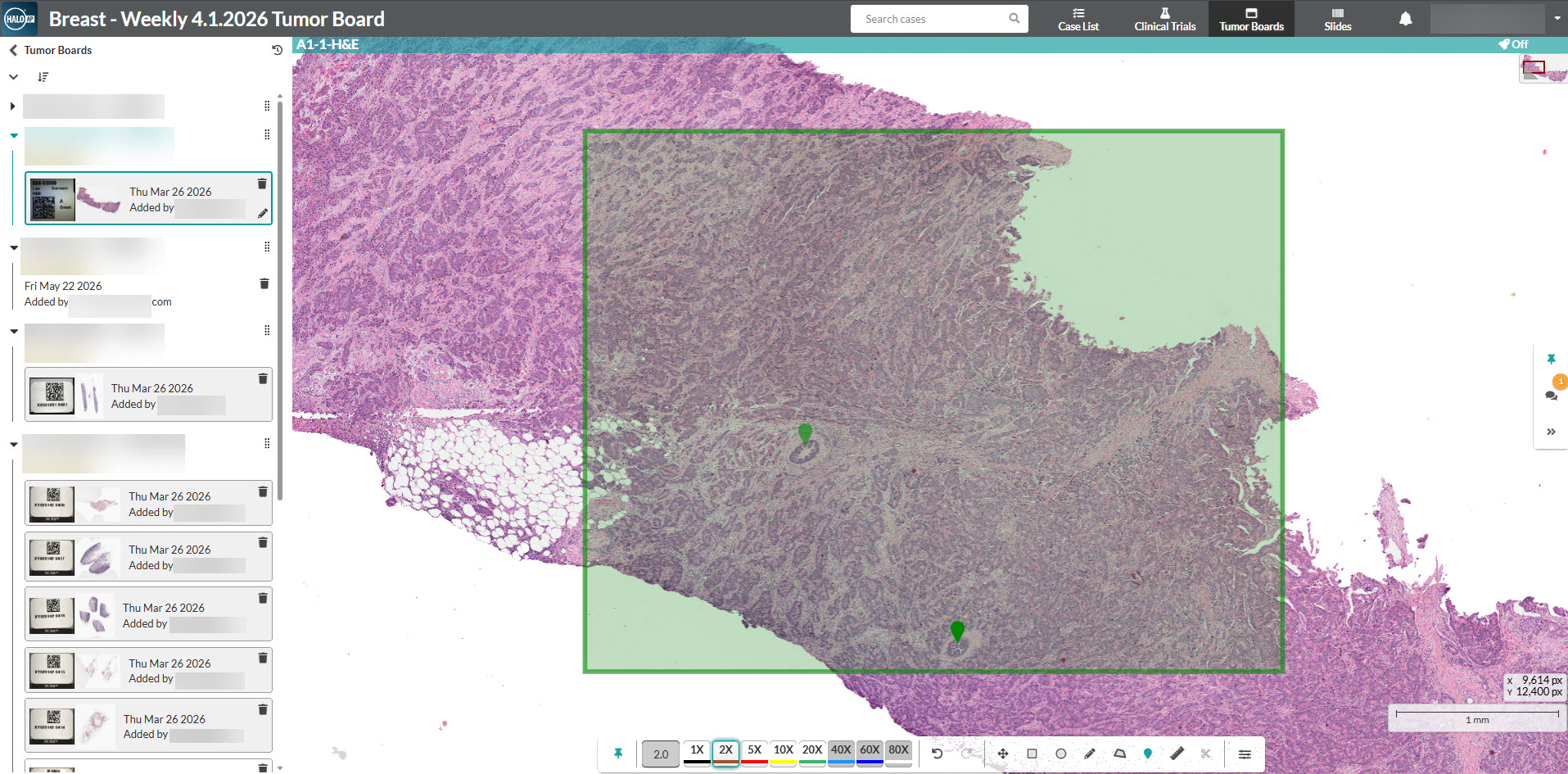 This image shows the HALO AP 2.5 user interface, show casing tumor board 2.0 for multidisciplinary collaboration in diagnostics