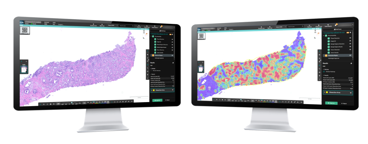 Prostate Macrodissect AI enables pathologists to identify and quantify tumor-rich regions in prostate specimens with precision. Improving macrodissection accuracy, maximizing NGS tumor content, and reducing QNS failures, a critical advancement in the molecular profiling of the most commonly diagnosed cancer in men.