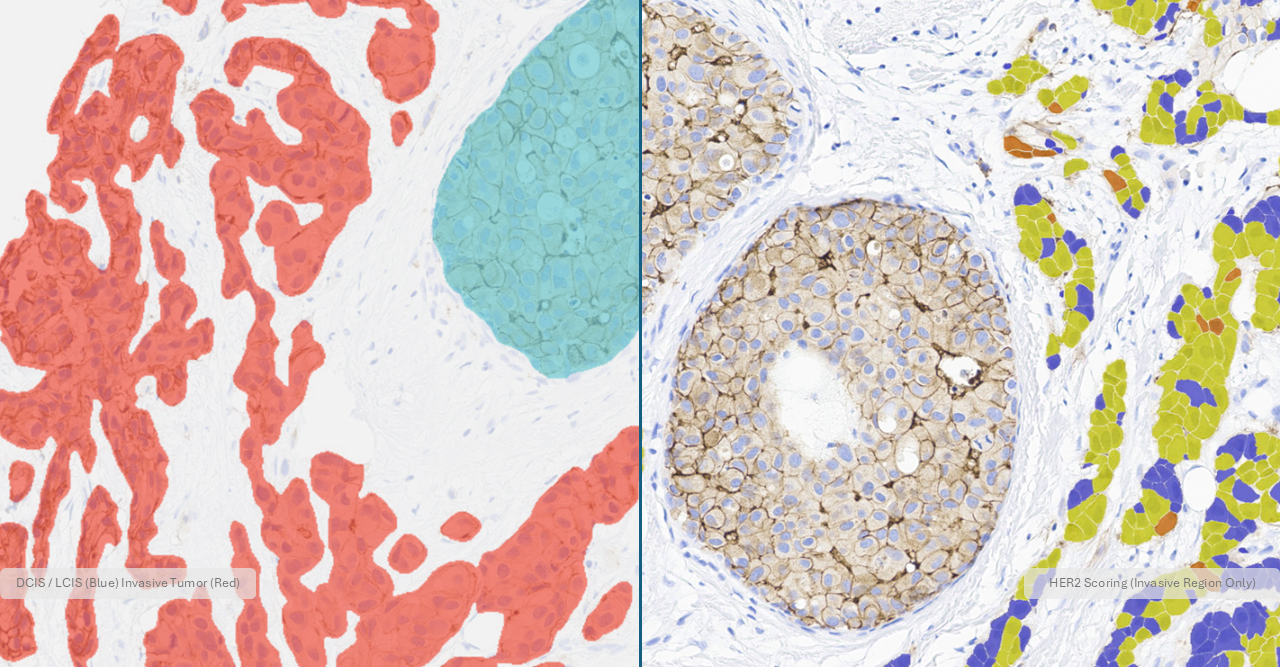 New zero-click preprocessing automatically identifies invasive carcinoma and excludes DCIS, LCIS, and control tissue before ER, PR, HER2, and Ki67 quantification. Shown here is the HALO Breast IHC AI out put of a stained HER2 slide with AI overlay only in the regions of invasive cancer.
