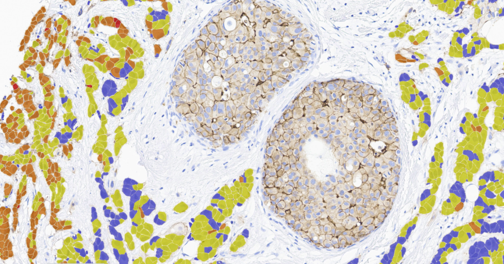 The image shows a HER2 IHC stained tissue specimen of invasive breast cancer with AI HER2 overlay in the invasive regions only and HER2 IHC staining with no ai overlay in the DCIS / LCIS regions of the tissue sample.