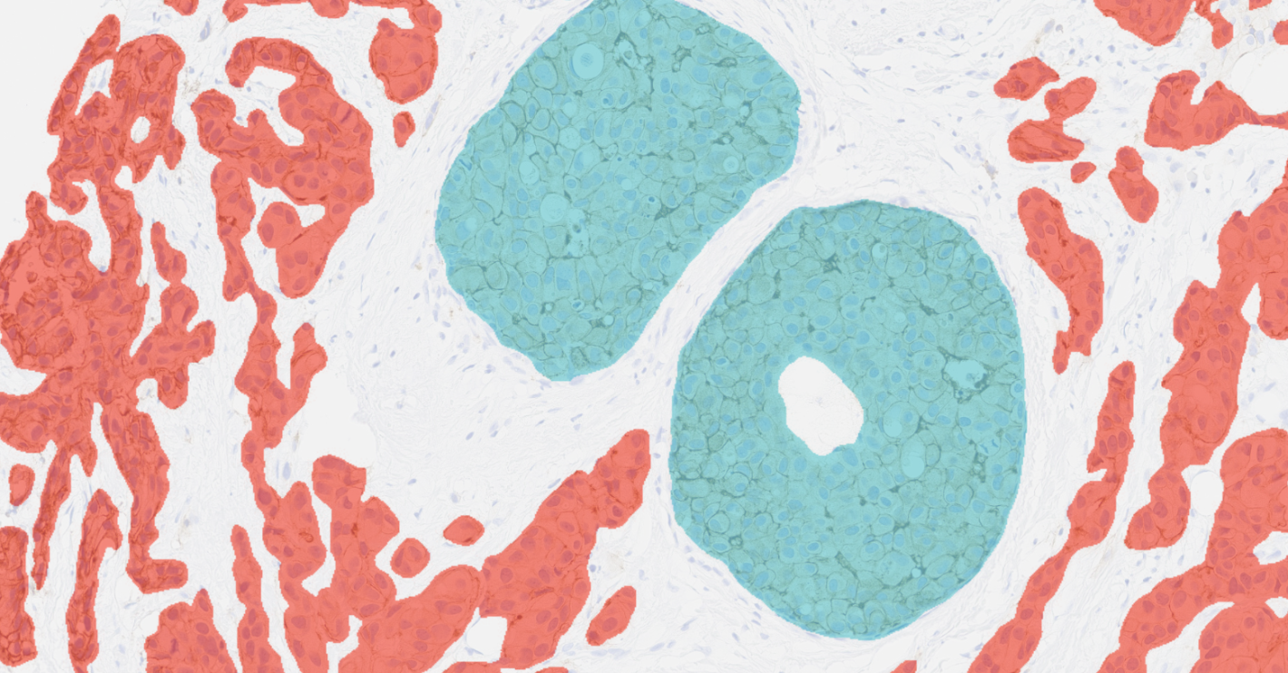 DCIS / LCIS (Blue) Invasive Tumor (Red)