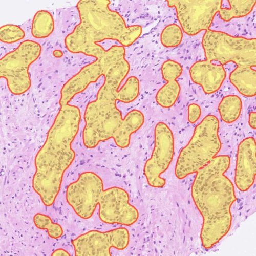 halo-prostate-ai-markup-image