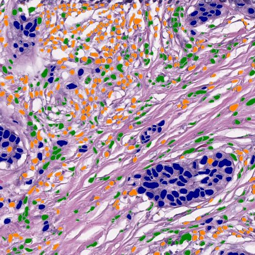 pan cancer h&E lymhocyte cell phenotyper-markup2